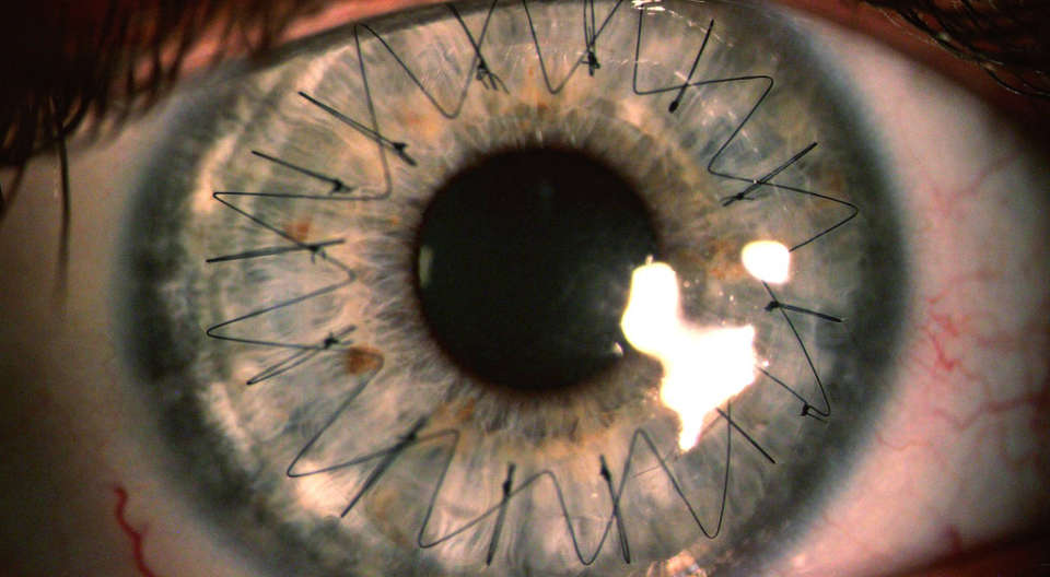 Новое в трансплантации роговицы глаза