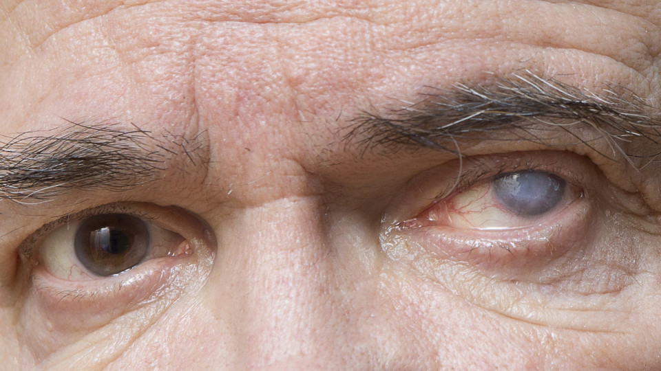 Эндотелиально-эпителиальная дистрофия роговицы (ЭЭД) после катаракты