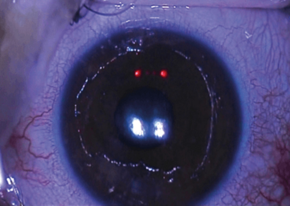 Глаз с удалённым эпителием для Epi-Off кросслинкинга