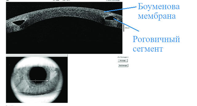 Фемтолазерная имплантация роговичных сегментов при кератоконусе