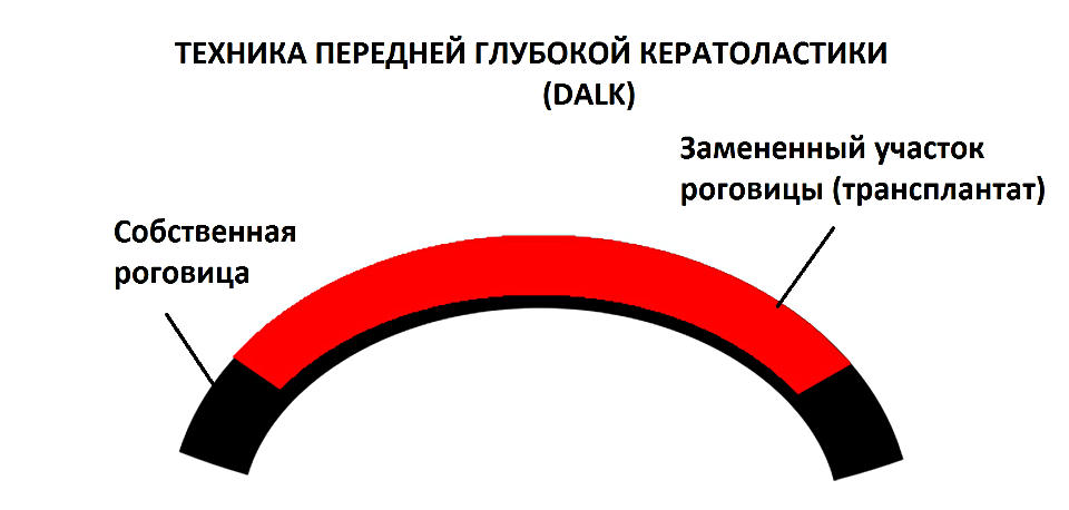 Передняя послойная глубокая кератопластика (DALK) при кератоконусе - цена в Москве