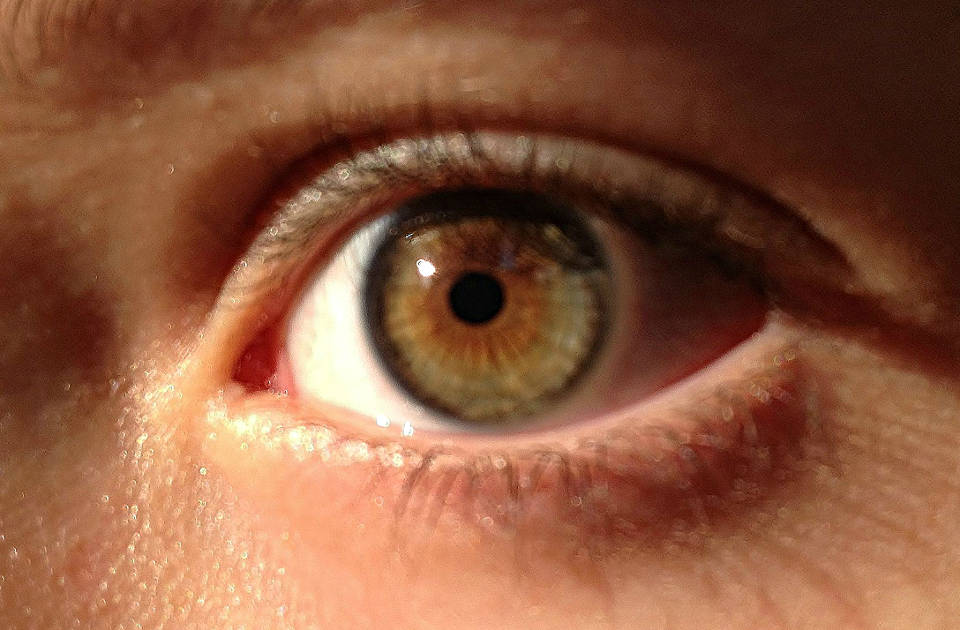 Кератоконус глаза - что за болезнь?