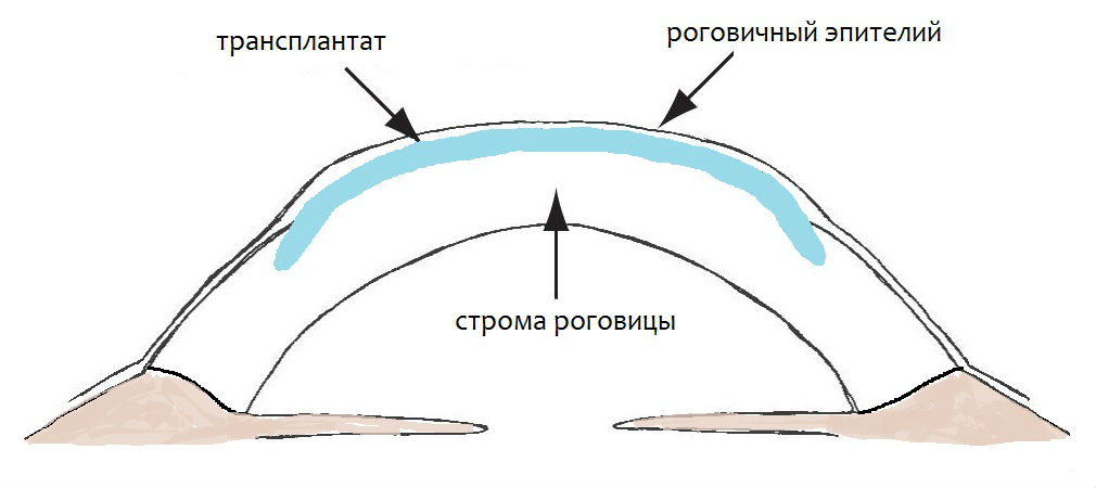 Эпикератопластика при кератоконусе - цена в Москве