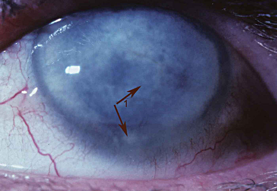 Эпителиальная передняя дистрофия глаза человека