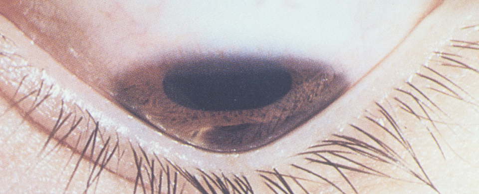 Кератоконус роговицы глаза - причины возникновения
