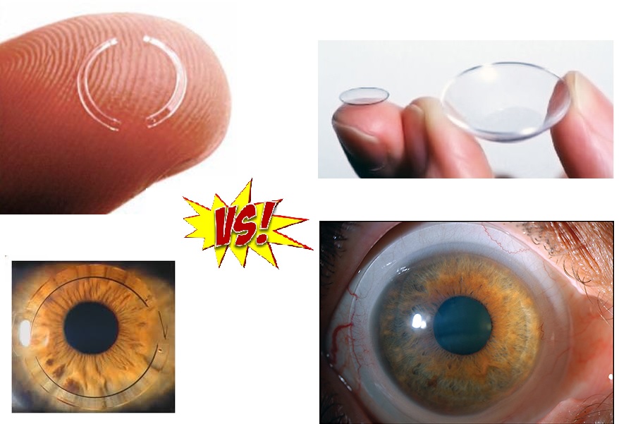 Что лучше при кератоконусе - роговичные кольца или контактные линзы?