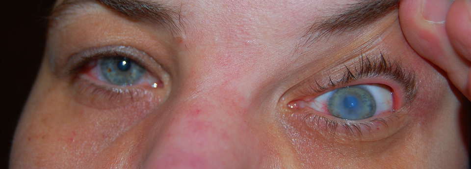 Острый кератоконус (водянка роговицы глаза, гидропс)