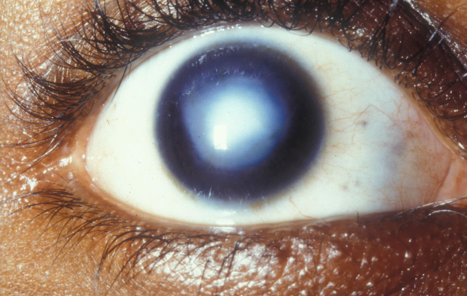 Помутнение роговицы глаза человека (бельмо)