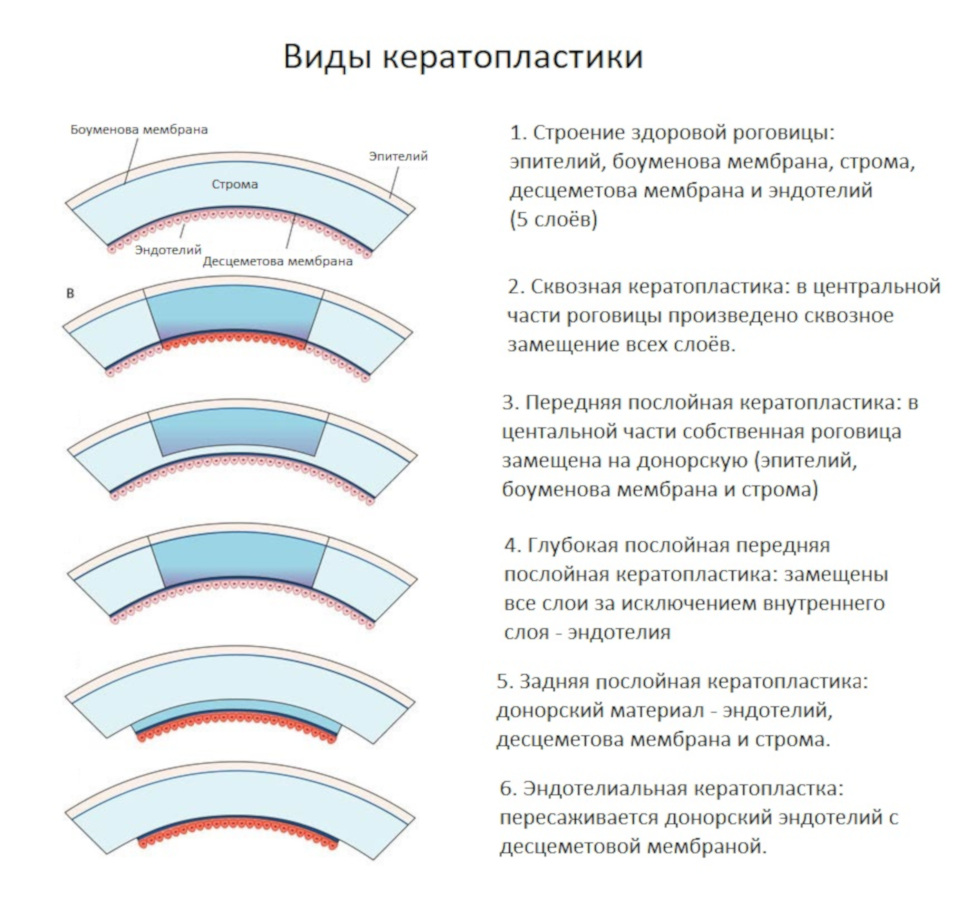 Кератопластика. Лечебная послойная кератопластика. Классификация кератопластик. Послойная кератопластика показания. Виды кератопластики, показания.