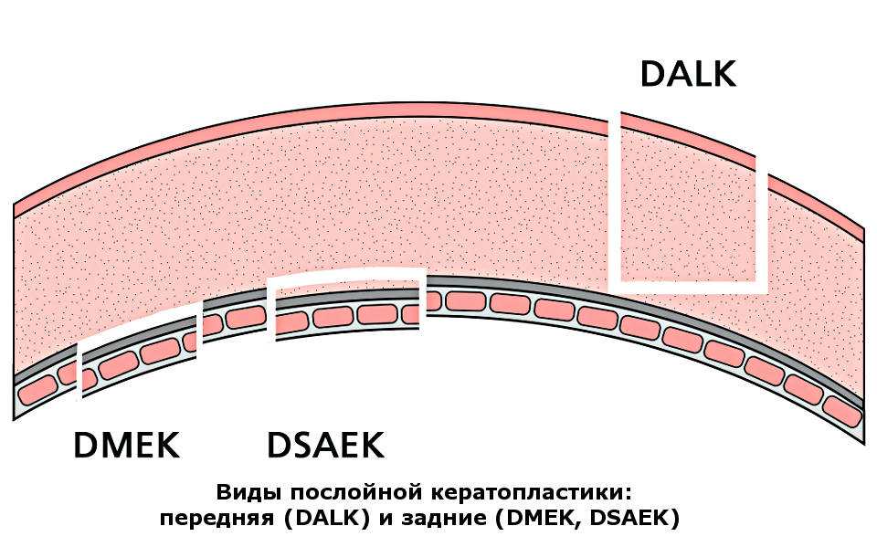 Операции на роговице глаза в Москве: кератопластика (DALK, DMEK, DSAEK)