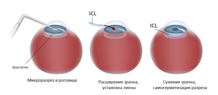 Цены и отзывы после операции установки ICL - имплантируемой интраокулярной линзы из колламера в Москве