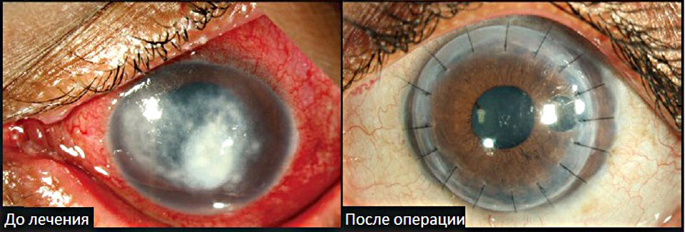 Заболевания роговицы глаза: диагностика и методы лечения