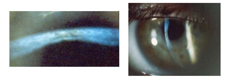 Задний кератоконус роговицы глаза лечение