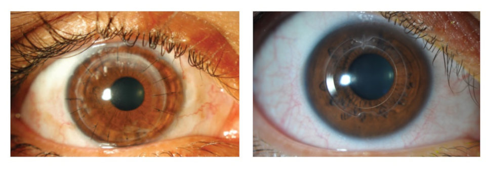 Роговица глаза после сквозной кератопластики и имплантации роговичных колец при кератоконусе