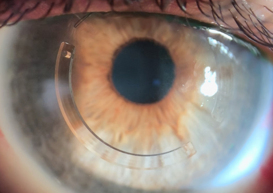 Глаз с установленными интрастромальными роговичными сегментами