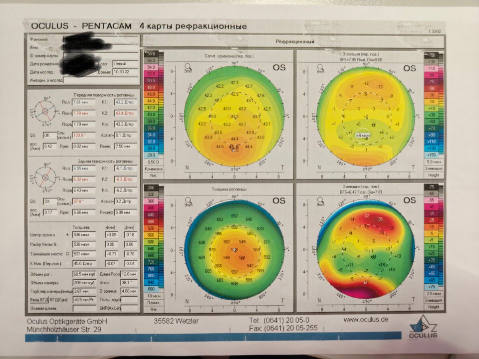 Элевация задней поверхности роговицы перед лазерной коррецкией зрения - стоит ли беспокоиться