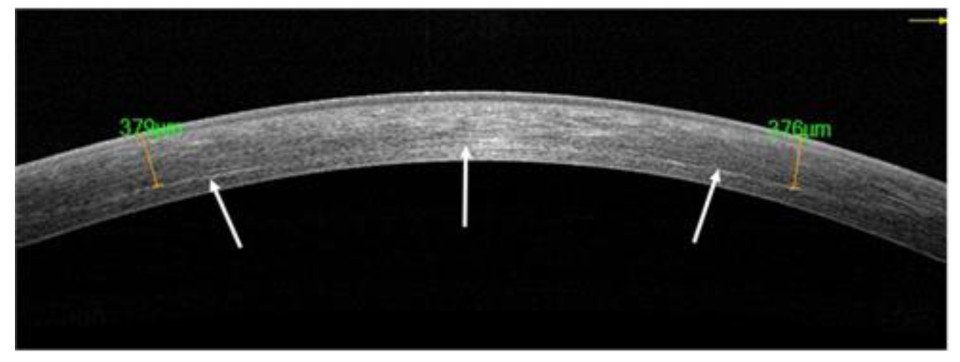 ОКТ роговицы через 1 месяц после КРК с демаркационной линией (показана стрелками)