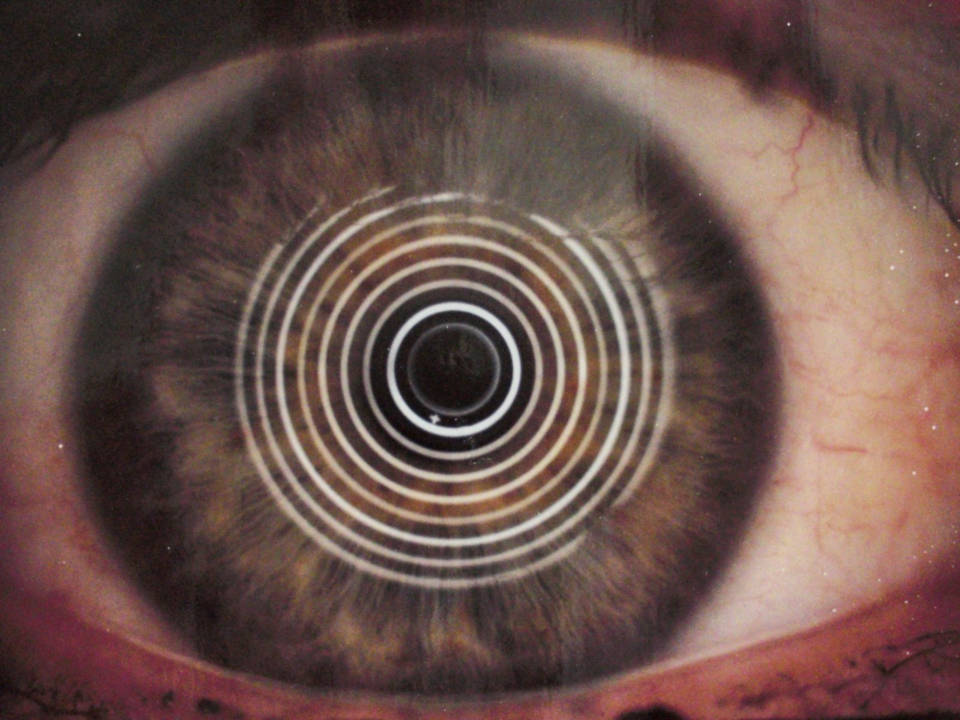 Правильные кольца при кератоскопии - здоровый глаз