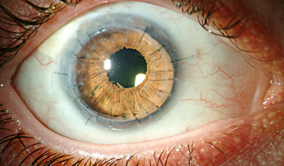 Операции при дистрофии роговицы глаза