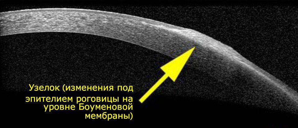 ОКТ роговицы при дистрофии Зальцмана &ndash; патологические участки под эпителием в области Боуменовой мембраны.