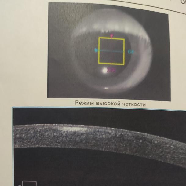 Лечение помутнения роговицы глаза с помощью ФРК и ФТК
