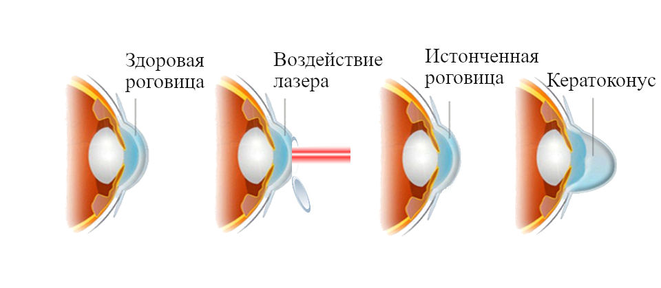 Кератоконус лечение. Вторичный кератоконус. Стадии кератоконуса. Кератоконус классификация.
